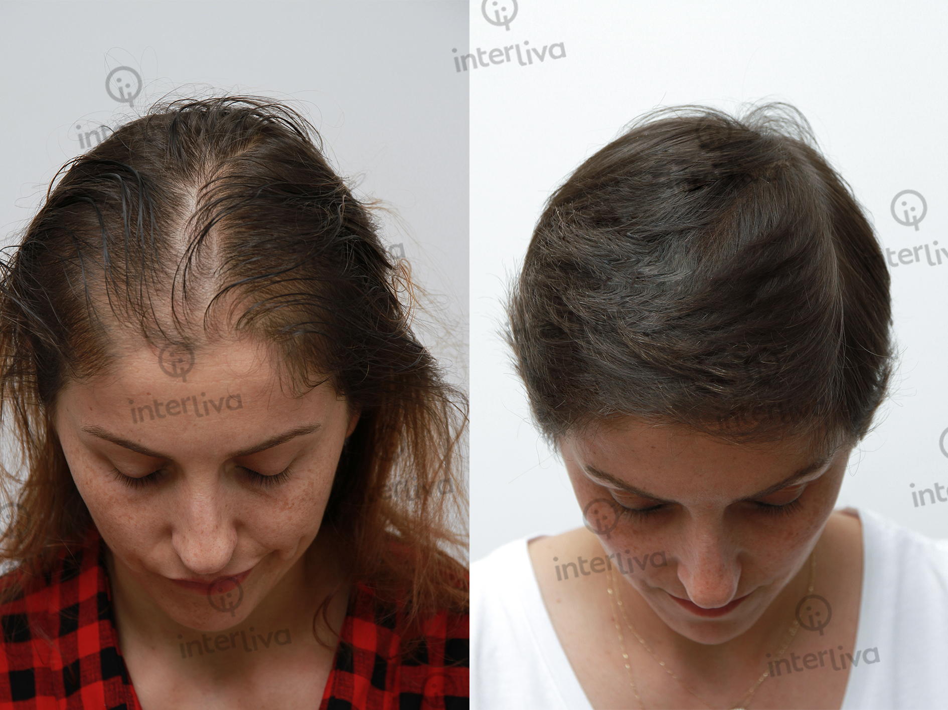 FUE Hair Transplant - Interliva
