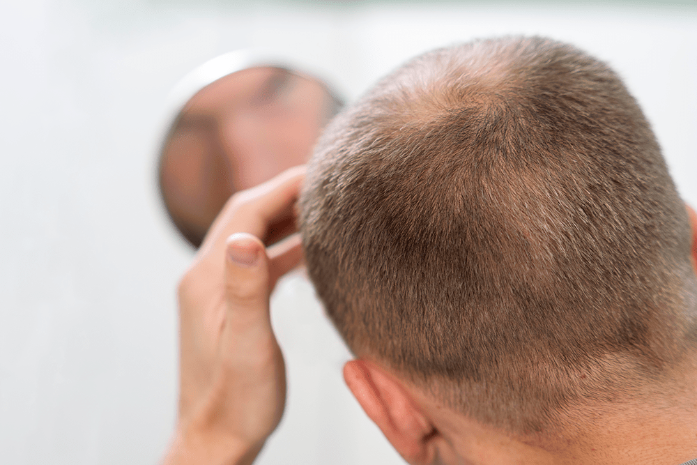 adult-male-having-balding-problems-min